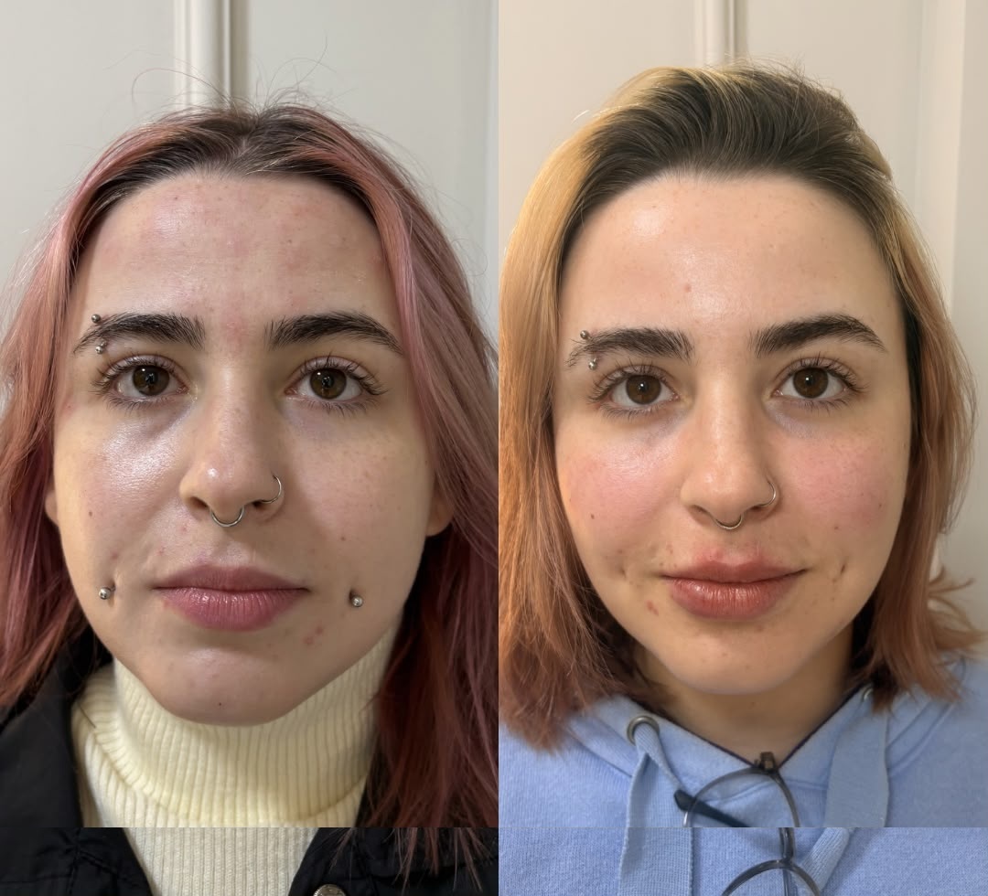 Antes e depois de harmonização facial