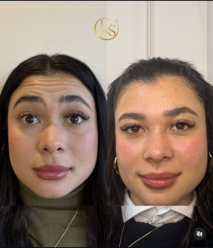 Antes e depois de harmonização facial